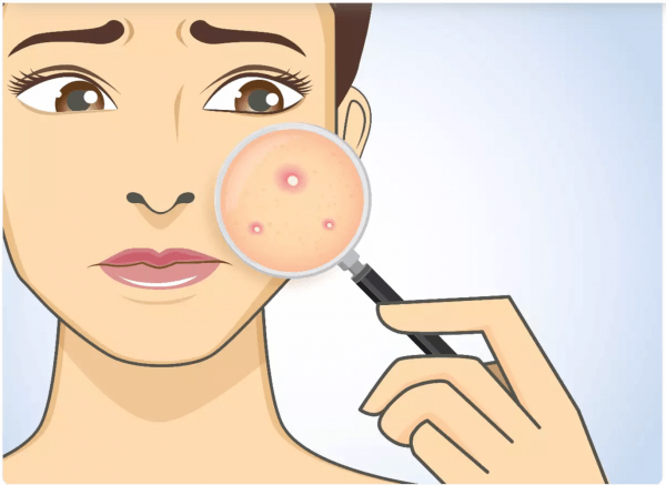 Habits To Avoid For Acne Prevention